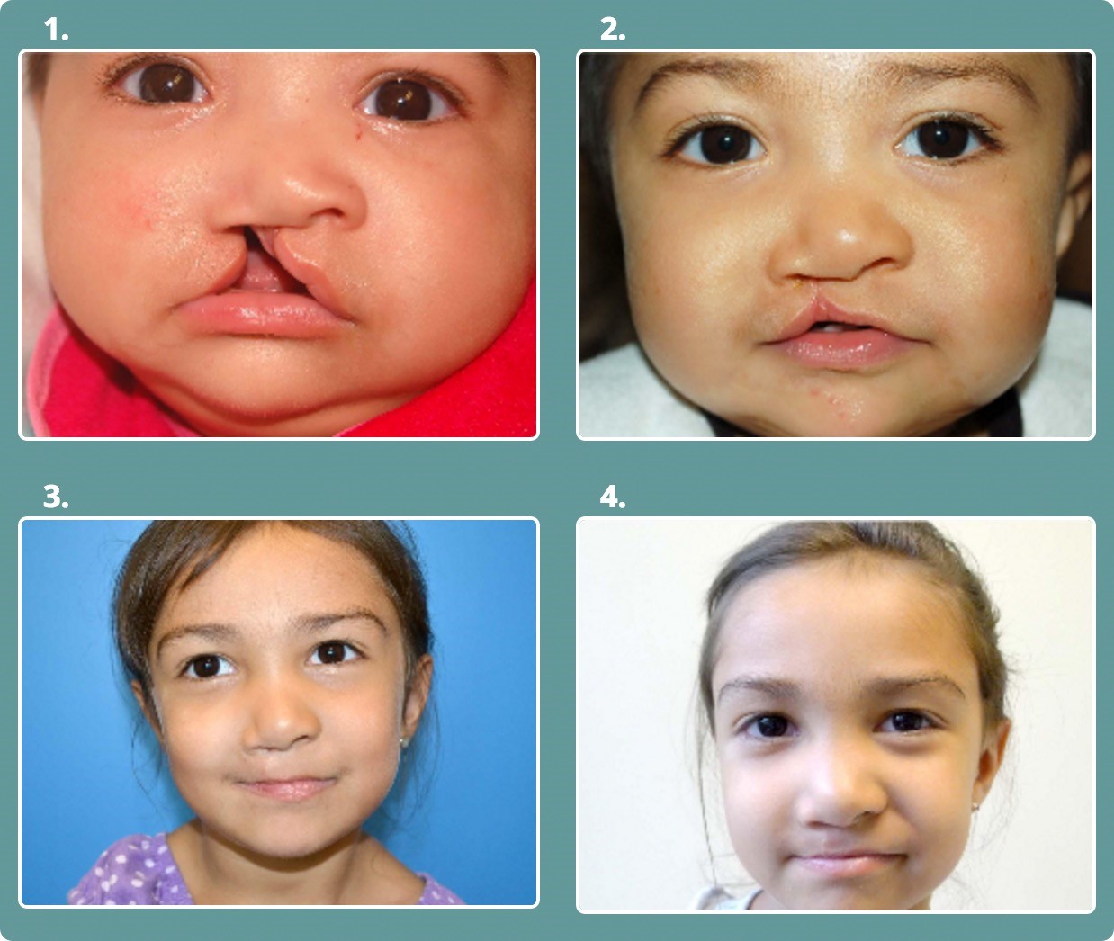 Surgical Management Cleft Lip And Palate