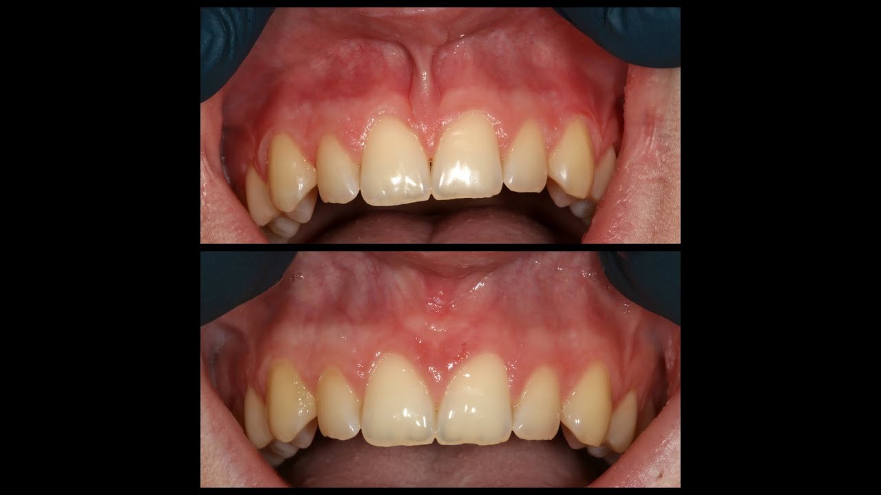 Frenectomy Green Park Dental Hospital