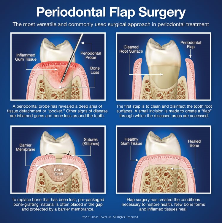 Periodontal Flap Surgery Green Park Dental Hospital