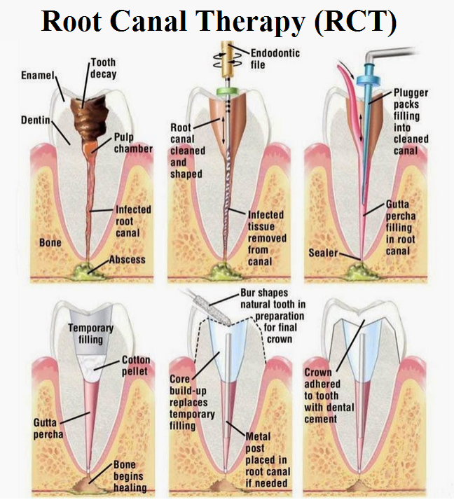 root-canal-treatment-green-park-dental-hospital