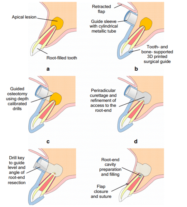 Apicoectomy - Green Park Dental Hospital