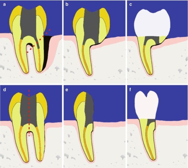 Tooth Bisection Hemisection Treatment | Green Park Dental Hospital