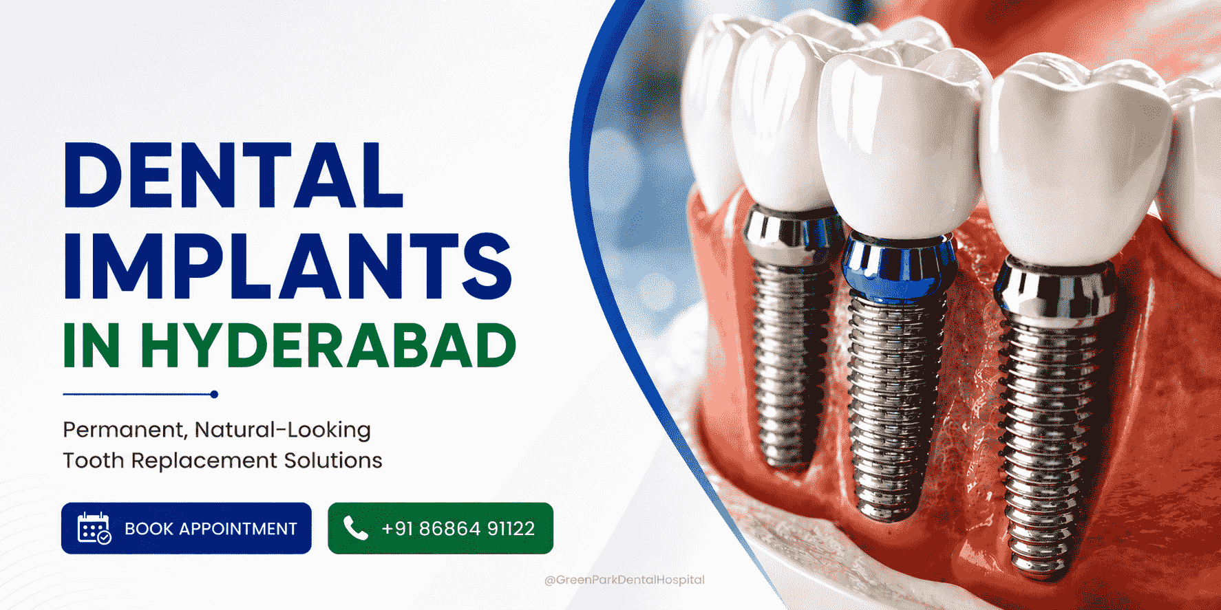 Dental Implants