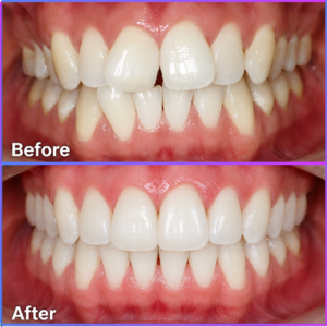 Invisalign Aligners in Champapet
