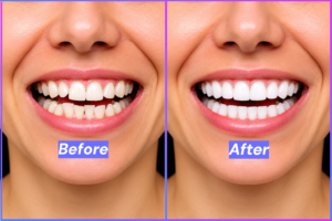 Invisalign Aligners in Karmanghat