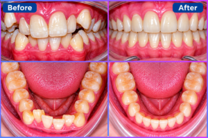 Invisalign Aligners in Hyderabad