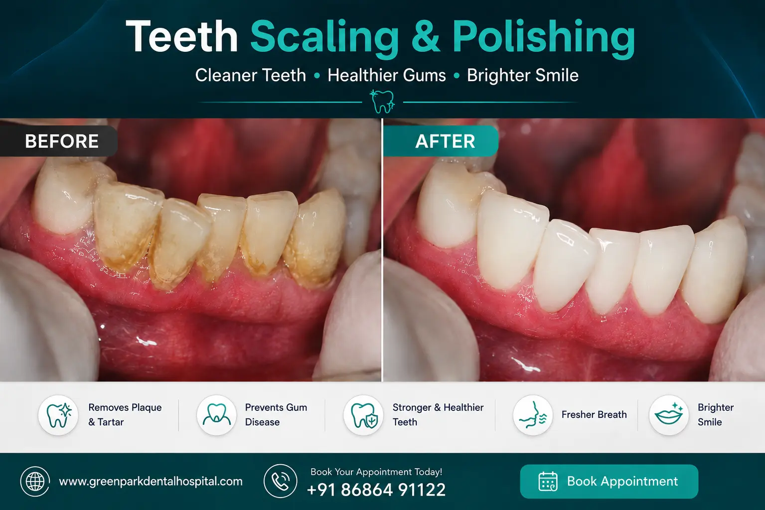 Scaling & Polishing