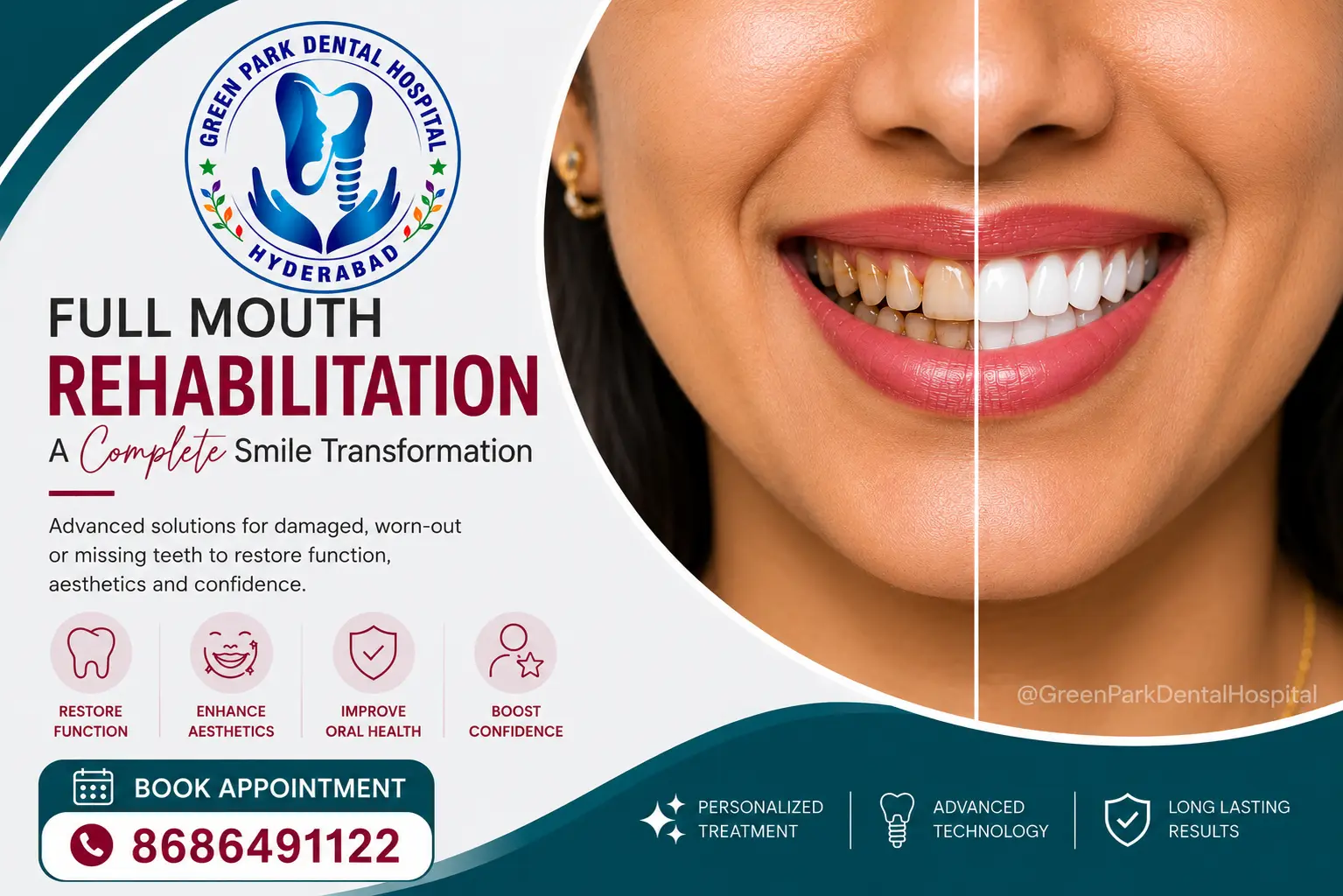 Full Mouth Rehablitation