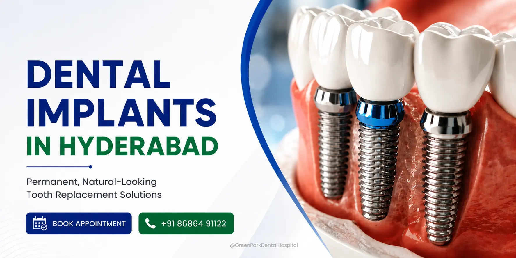 Dental Implants