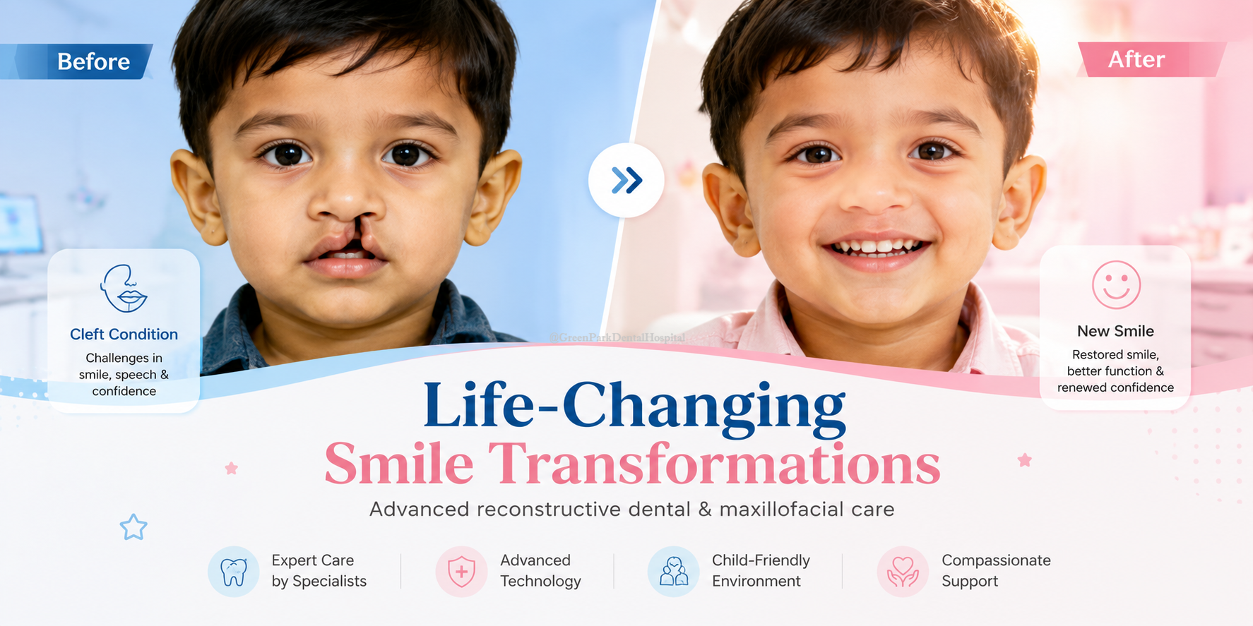 Cleft Lip & Cleft Palate